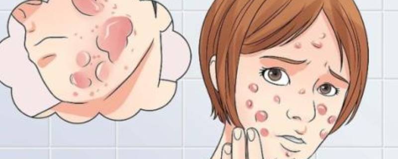 青春痘怎么消除小妙招